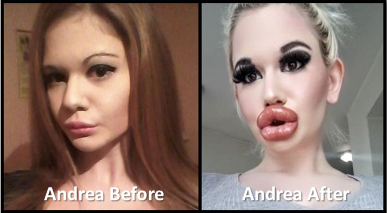 Andrea Ivanova, influencer who had 20 lip injections